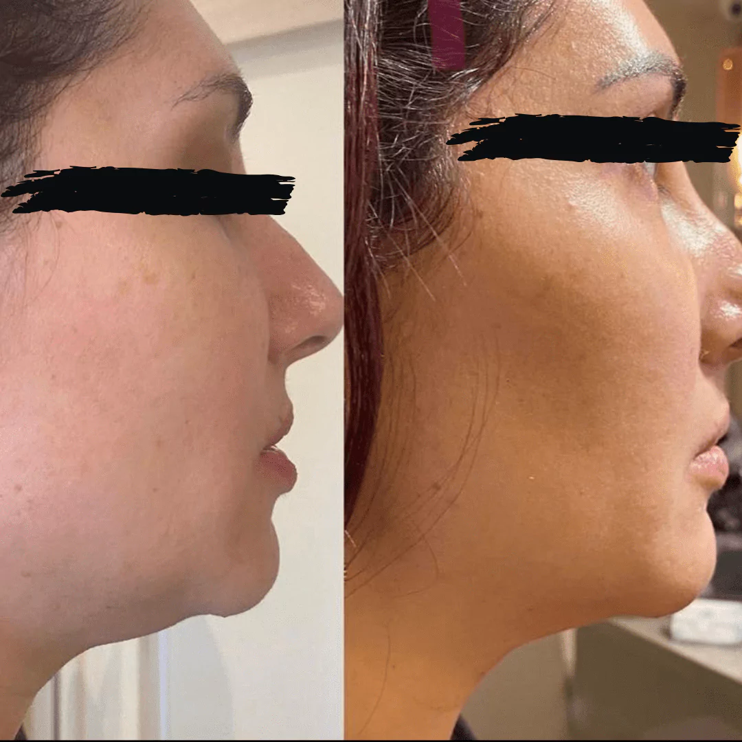 lipo-enzimatica-de-papada-688d3e6b249ef