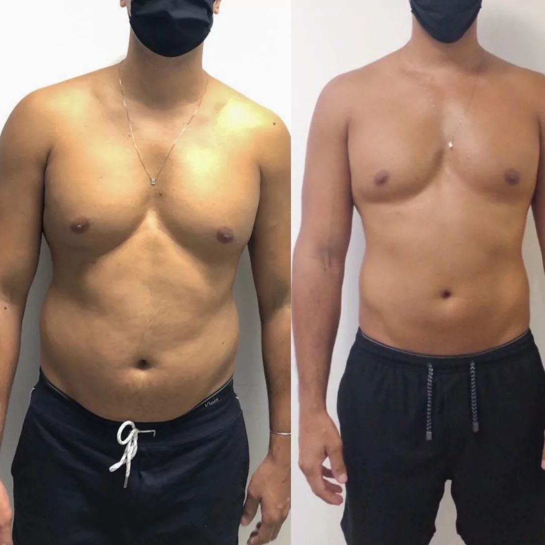 lipo-enzimatica-definicao-abdominal-688d3e6853265